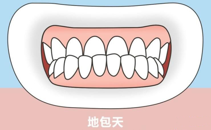 如果孩子有“地包天”，該怎么辦？
